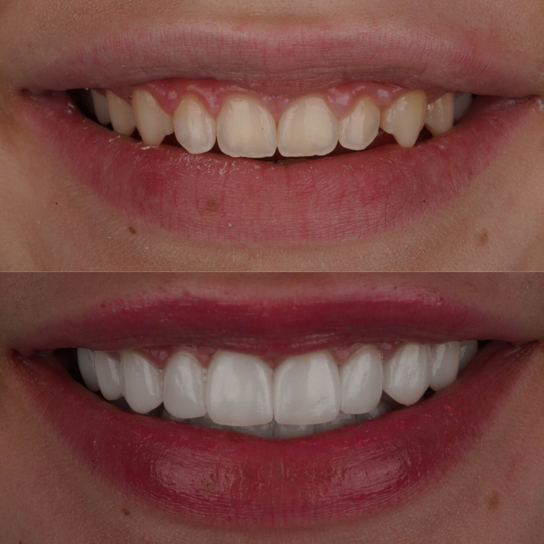 Before and after porcelain veneers for a brighter smile